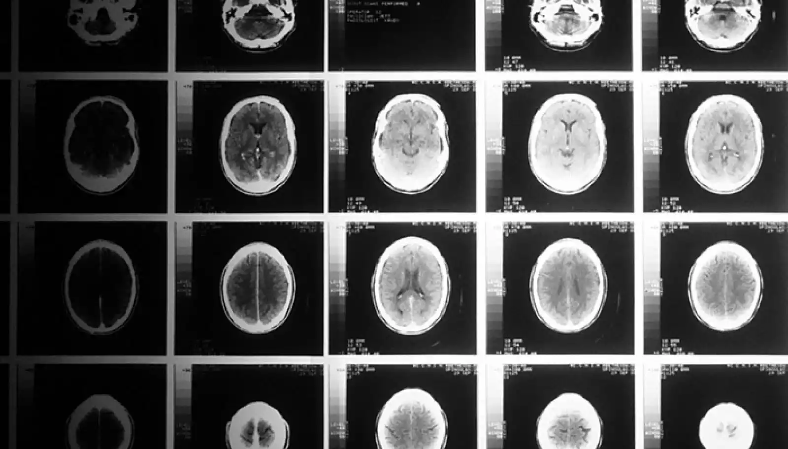 Dementia now leading cause of Death in England and Wales - The importance of an LPA